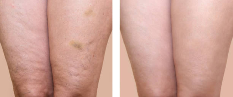 Why do I have cellulite?